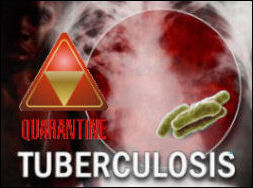 Tuberculosis Quarantine